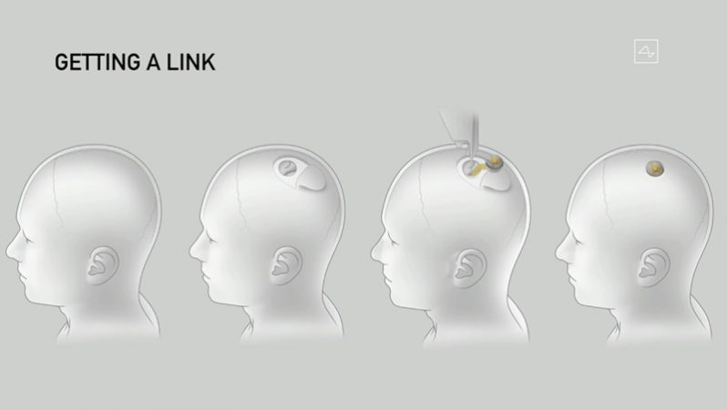 Demonstração de como é feito o implante Neurolink