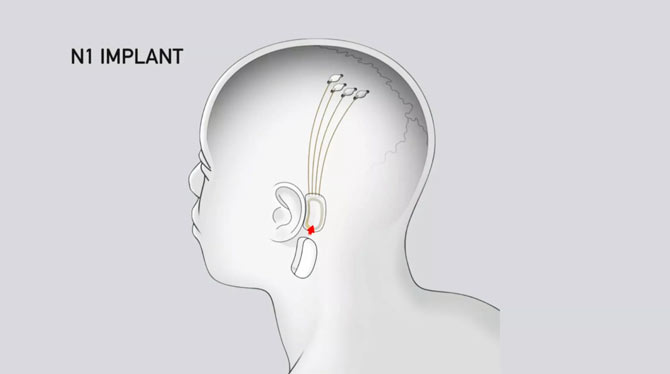 Implante da Neurolink previsto para acontecer em breve